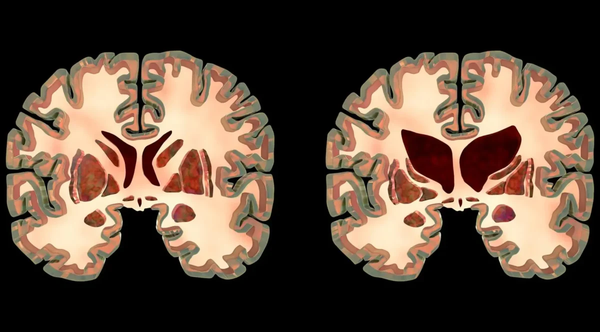 Huntington’s Disease and Gene Therapy